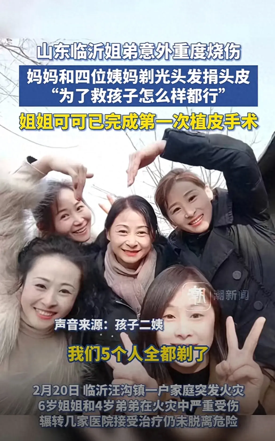 姐弟燒傷四位姨媽剃光頭捐頭皮